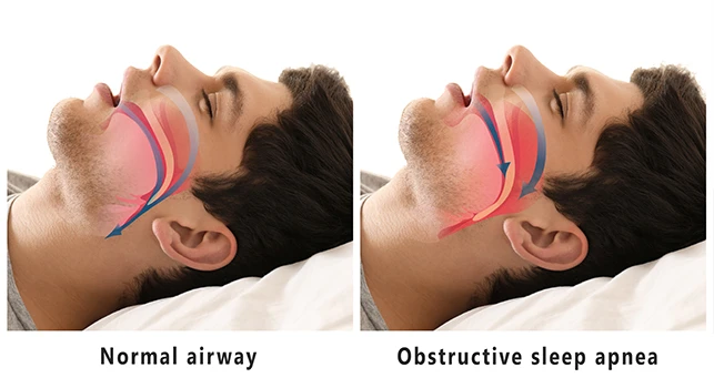 Image showing Obstructive Sleep Apnea